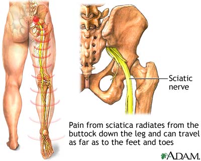 Herbal Treatments on Natural Treatment For Sciatica Pain