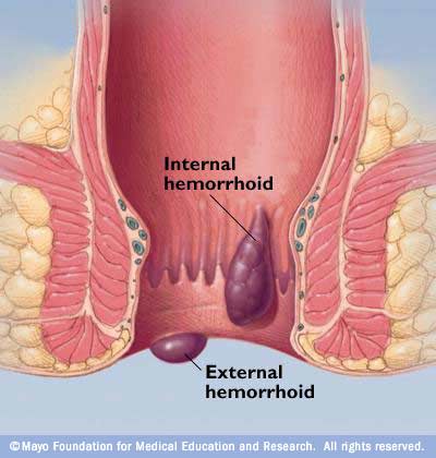 Hemorrhoid during pregnancy