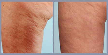 Cellulite Treatment in a Single Laser Treatment with Cellulaze 