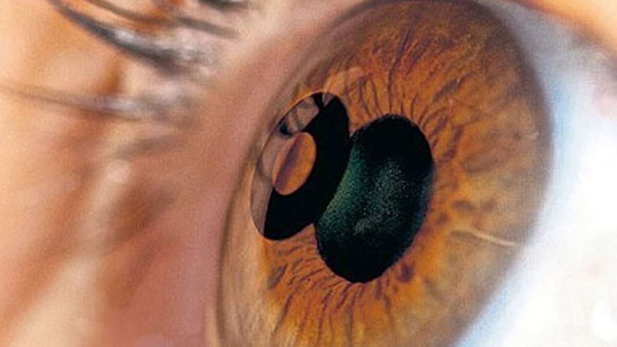 New Procedure to Eliminate Reading Glasses Laser Eye