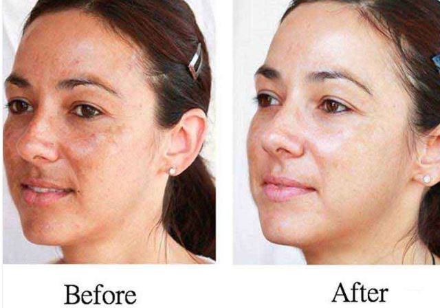 First Impressions Last With Meladerm Skin Lightening Cream 