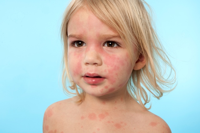 Skin Infections In Children Symptoms And Treatment Dr Mubina 